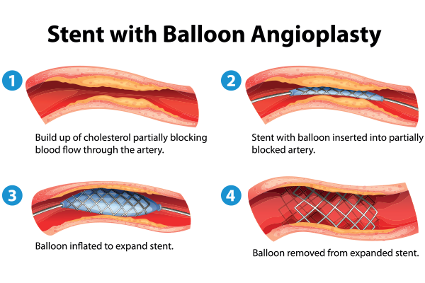 how a coronary stent works